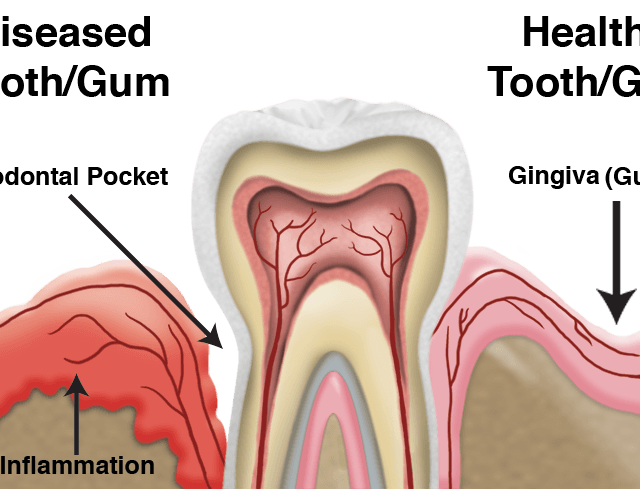 https://evolutiondentalcare.com.au/wp-content/uploads/2022/06/HealthyGumsvsUnhealthyGums-640x489.png