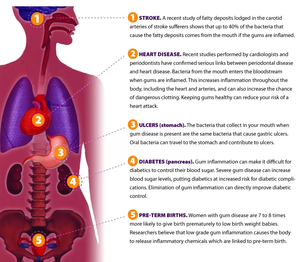 https://evolutiondentalcare.com.au/wp-content/uploads/2022/06/Perio-Graphic-1024x900-1.webp