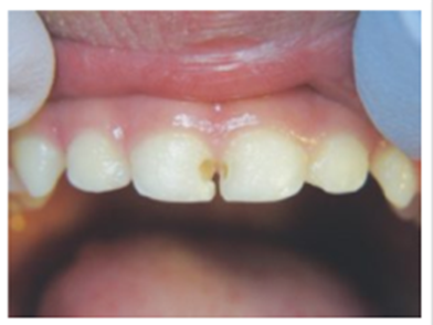 https://evolutiondentalcare.com.au/wp-content/uploads/2022/06/before.png